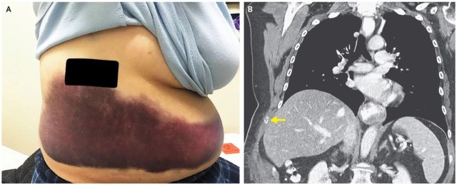 Tulang rusuk yang patah akibat batuk keras. (Foto: The New England Journal of Medicine)