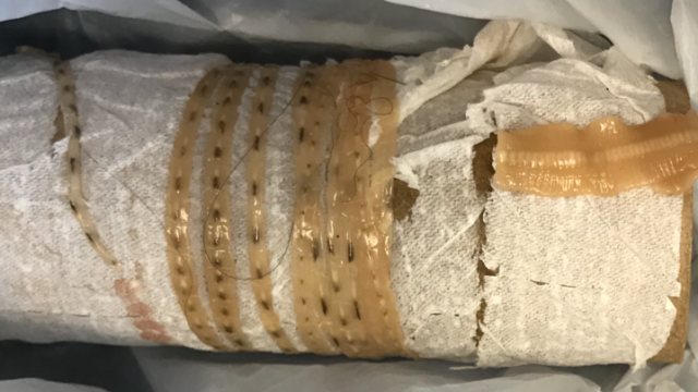 Cacing pita di perut pria AS (Foto: Dok. DR Kenny Bahn)