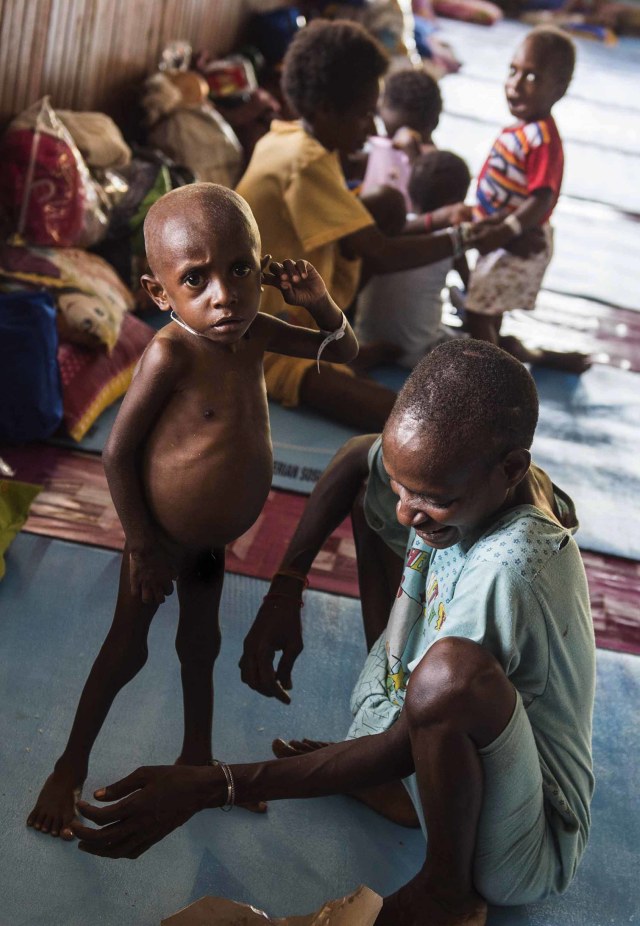 Penderita Gizi Buruk di Asmat Foto: ANTARA FOTO/M Agung Rajasa