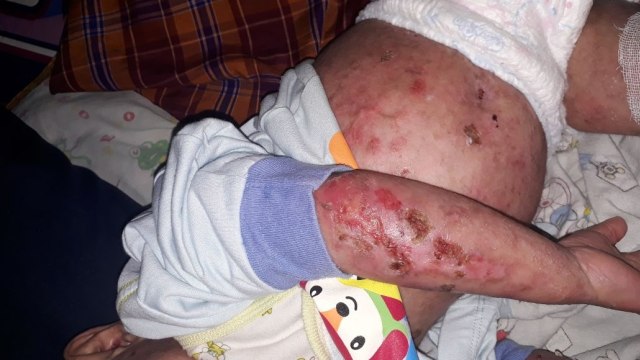 Luka di tubuh bayi Waqi (Foto: Dok. Eti)