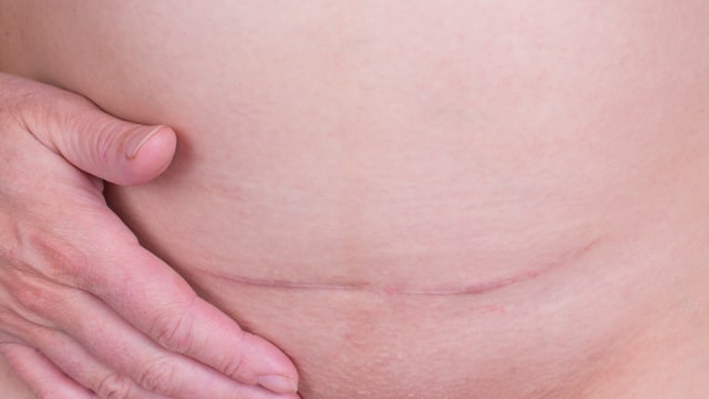 Ilustrasi melahirkan caesar (Foto: Thinstock)