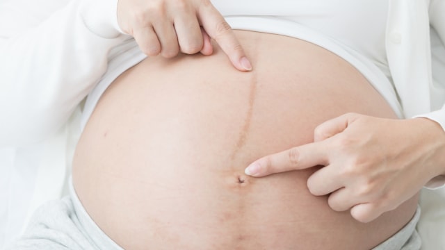 Ilustrasi Garis Kehamilan (Foto: Thinsktock)