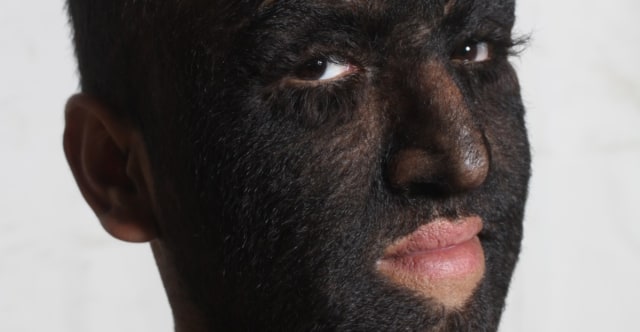 Hypertrichosis yang Tidak Berkaitan dengan Mistis