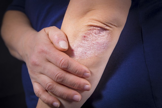 Psoriasis (Foto: Thinkstock)