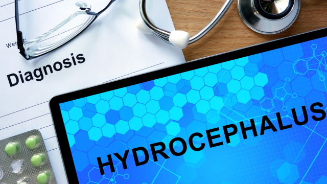 Ilustrasi Hidrosefalus. (Foto: Thinkstock)