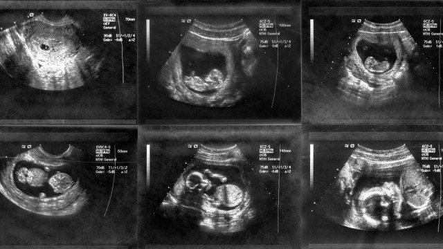 Ilustrasi janin dalam kandungan. (Foto: Thinkstock)