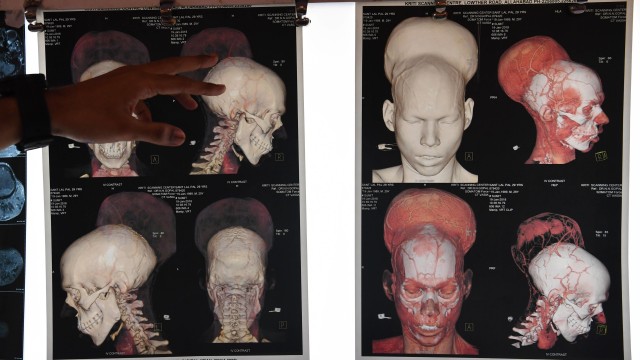 Tumor otak Santlal Pal (Foto: Indranil Mukherjee/AFP)