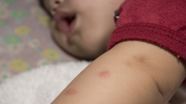 Gigitan nyamuk pada anak. (Foto: Thinkstock)