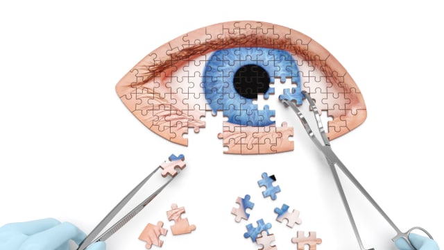 Ilustrasi Katarak (Foto: Thinkstock)