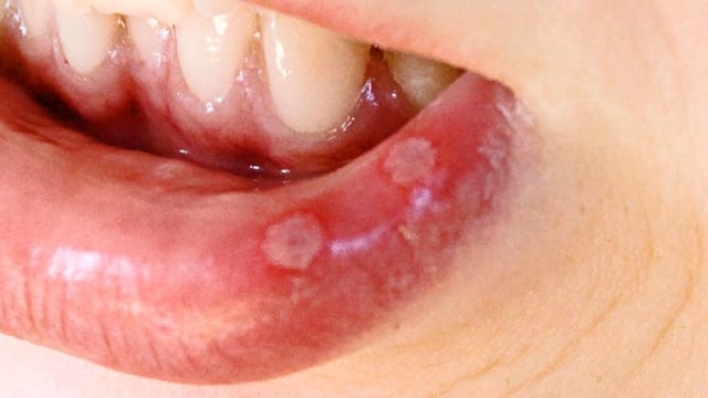 Sariawan  (Foto: Wikimedia Commons)