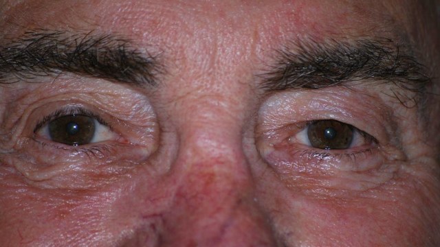 Kebutaan akibat faktor usia (Foto: Public Domain Pictures)