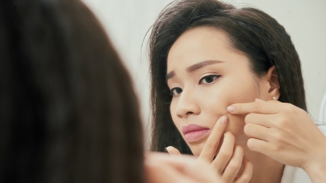 Ilustrasi wajah berjerawat. (Foto: Thinkstock)