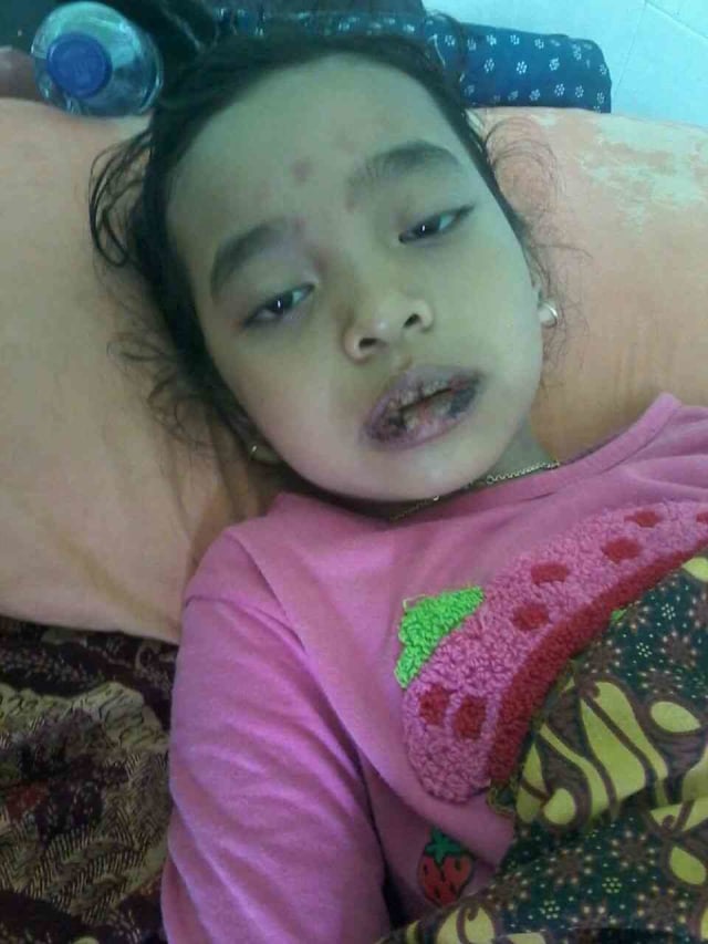 Siswa di Sumenep Mengalami Bengkak Bibir Usai Disuntik Vaksin Difteri