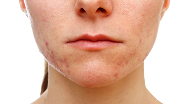 Ilustrasi rubella pada wanita. (Foto: Thinkstock)