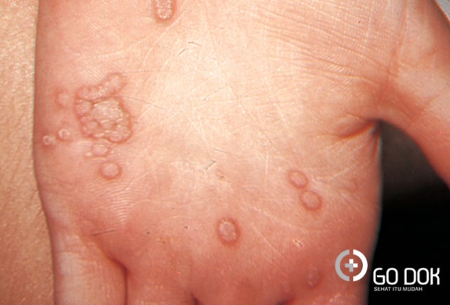 Kenali Penyakit Veruka Vulgaris