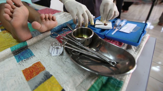 Ilustrasi sunat pada orang dewasa. (Foto: AFP/Mohd Rasfan)