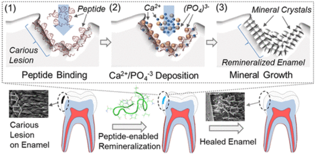 Pengobatan baru gigi berlubang. (Foto:  ACS Biomaterials Science & Engineering)