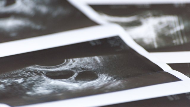 Ilustrasi hasil USG ibu hamil. (Foto: Thinkstock)