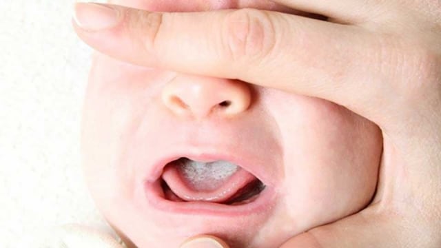 Lidah Putih Pada Bayi Akibat Infeksi Jamur