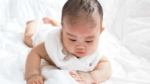 Mengatasi Dermatitis Seborik