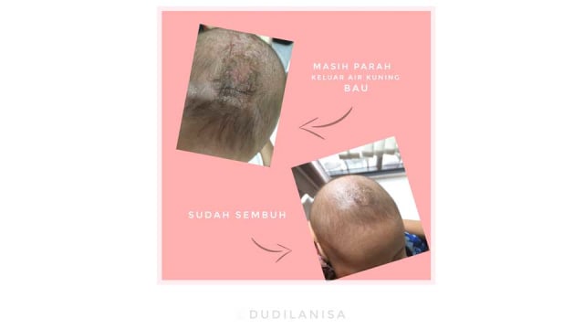 Mengatasi Dermatitis Seborik (2)