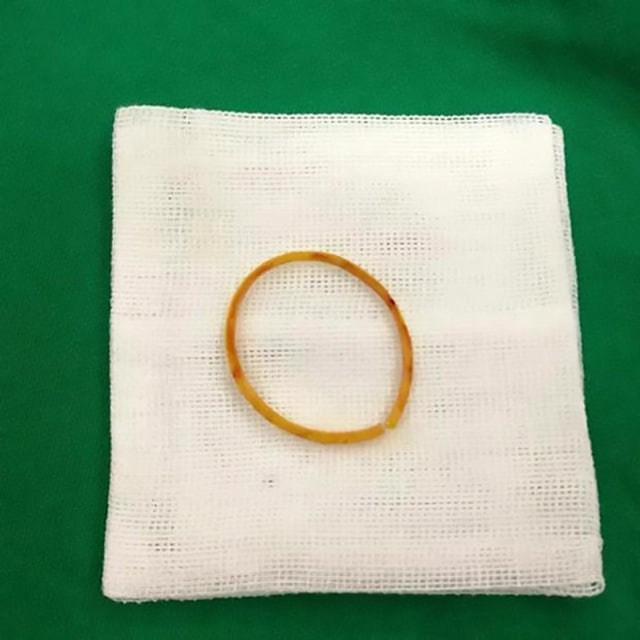 Karet gelang dalam tubuh Le Le (Foto: Asia Wire)