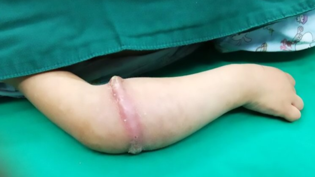 Karet gelang di tubuh Le Le (Foto: Asia Wire)