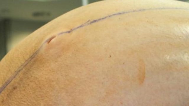 Tumor langka 60 kilogram. (Foto: Danbury Hospital)