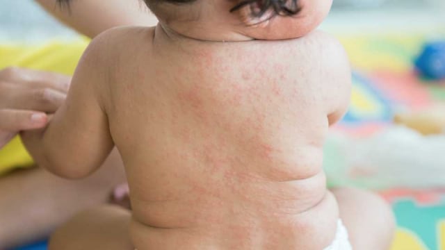 Waspada Si Kecil Alami Roseola Infantum