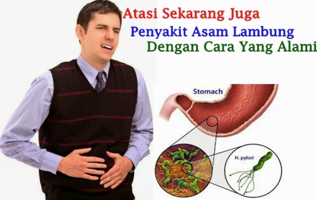 3 Cara Mengobati Asam Lambung Kronis Secara Alami Tanpa Obat