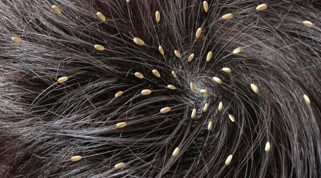 Waspada!! Ternyata Kutu Rambut Juga Bisa Tumbuh Di Area Ini 