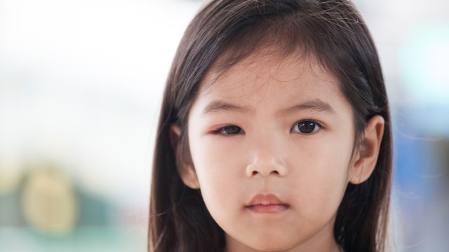 Rhinitis Alergi Bikin Mata Anak Bengkak, Apakah Berbahaya? Foto: Thinkstock