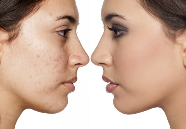 Purging pada wajah (Foto: Dok. Thinkstock)