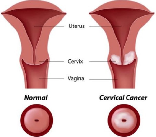 WASPADA KANKER! Jika Anda Mengalami Hal Ini Segera Lakukan Pemeriksaan!
