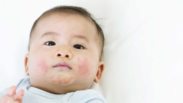 Mengenal Gatal Pada Bayi Yang Disebabkan Oleh Eksim