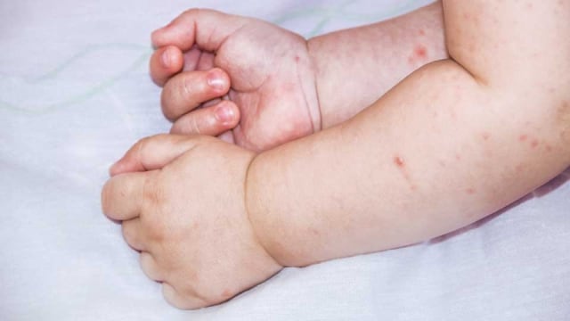 Waspada HFMD, dapat menular ke dewasa juga