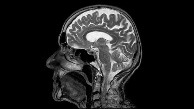 Ilustrasi x-ray otak. (Foto: toubibe via Pixabay)