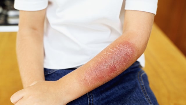 Ilustrasi luka bakar (Foto: thinkstock )