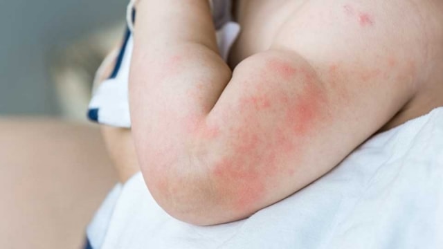 Ketahuilah Tanda Demam Berdarah pada Bayi