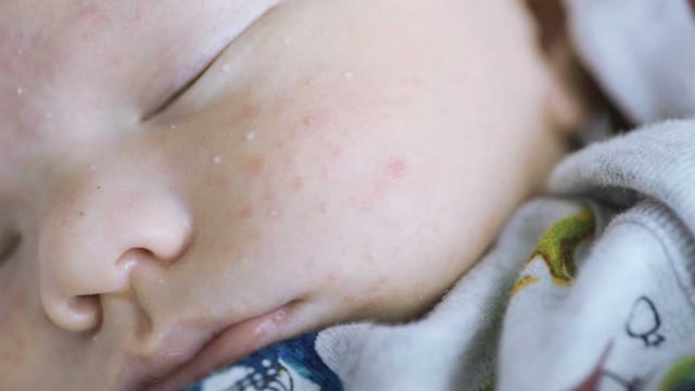 Bagaimana Mengatasi Jerawat Bayi?