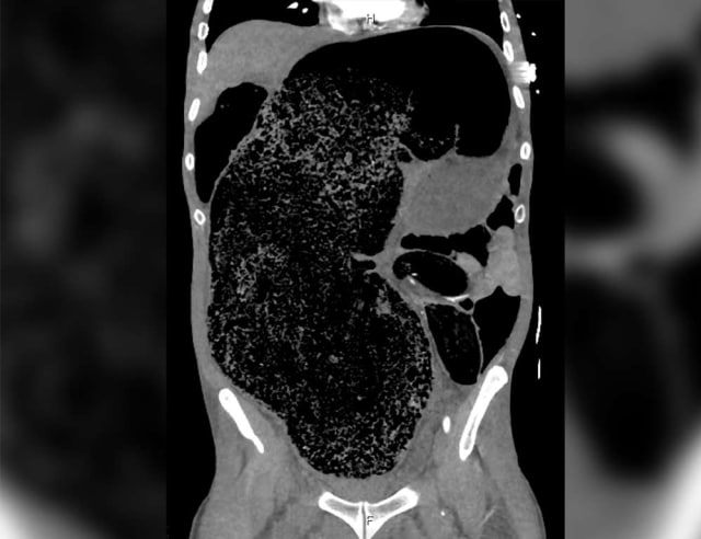 Hasil pemeriksaan perut pasien. (Foto: BMJ Case Reports)