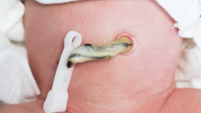 Abnormalitas pada Tali Pusat Single Umbilical Artery