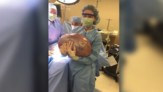 Tumor kistadenoma musinosum di tubuh Kayla Rahn. (Foto: Dok. Jackson Hospital)