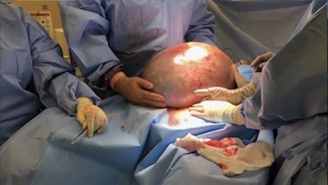 Tumor kistadenoma musinosum di tubuh Kayla Rahn. (Foto: Dok. Jackson Hospital)