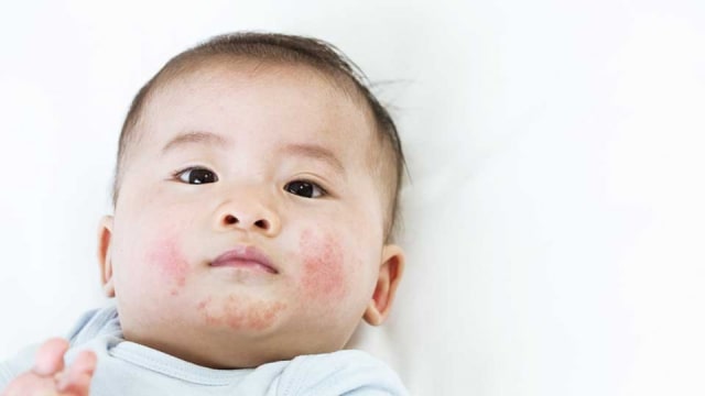 Penanganan Kulit Bayi Kering Hingga Eksim