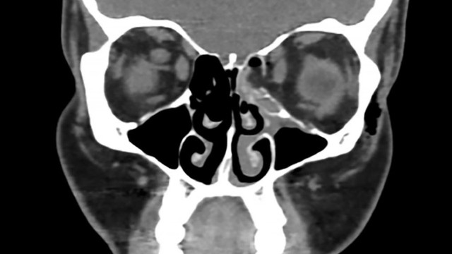 Hasil CT scan tulang wajah yang patah. (Foto: BMJ Case Reports)