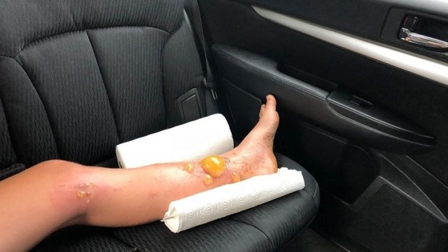 Luka yang dialami Charlotte Murphy. (Foto: Charlotte Murphy/Facebook)