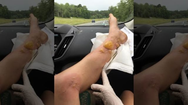 Luka yang dialami Charlotte Murphy. (Foto: Charlotte Murphy/Facebook)