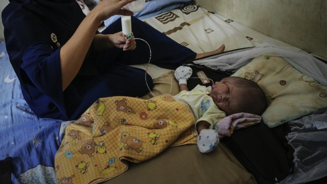 Gilang Andika, bayi yang lahir dengan 2 wajah (Foto: M N Kanwa/Antara )