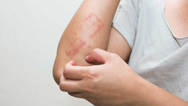 Saat Gatal Jangan Langsung di Garuk, Lakukan Ini!